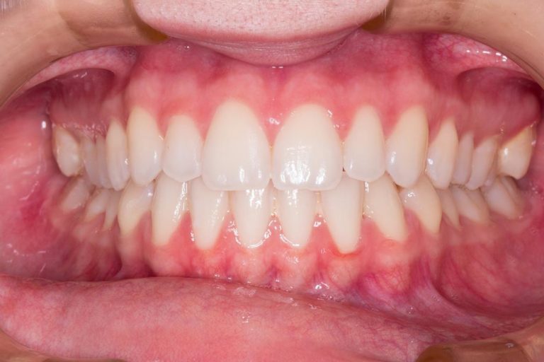 Przezroczysta nakładka prostująca zęby